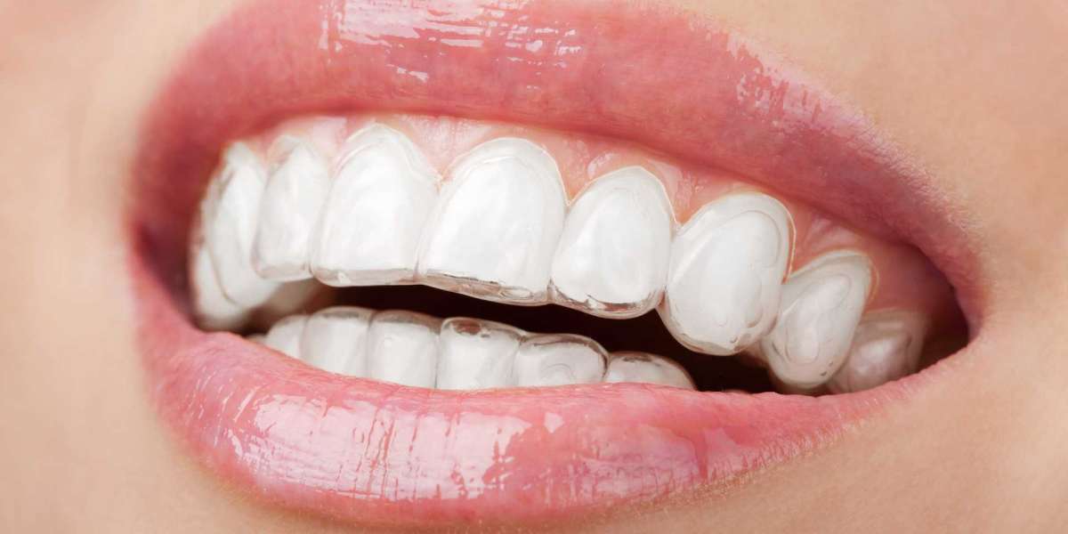 Brace Yourself: Navigating the World of Teeth Braces at Amma Naana Dental Clinic